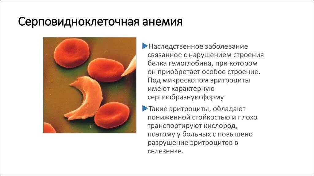 Селезенка и эритроциты. Гемоглобин s при серповидноклеточной анемии. Строение гемоглобина при серповидноклеточной анемии. Серповидно клеточная анемия картина крови. Серповидная анемия эритроциты.