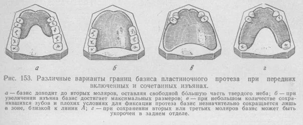 Границы пластиночного протеза. Границы базиса съемного протеза на нижней челюсти. Границы базиса протеза на верхней челюсти. Границы базиса съемного пластиночного протеза на нижнюю челюсть. Граница базиса протеза на верхней челюсти и нижней челюсти.