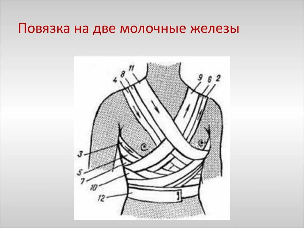 Десмургия повязка Дезо. Повязка на обе молочные железы техника наложения. Косыночная повязка Дезо. Повязка на грудную клетку Дезо. Перевязать молоко