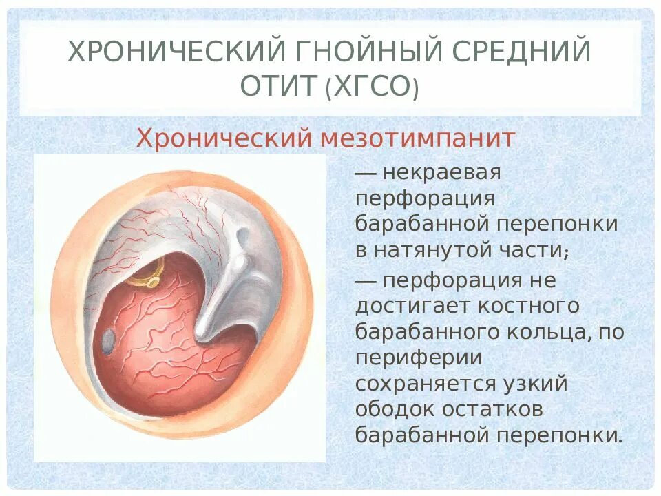 Хронические гнойные заболевания. Острый Гнойный средний отит (перфоративная форма). Мезотимпанит (туботимпанальный Гнойный средний отит); эпитимпанит. Мезотимпанит хронический средний Гнойный отит. Клинические симптомы хронического отита:.