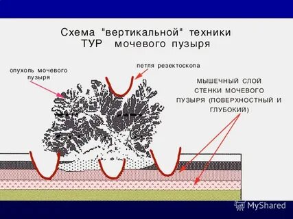Рак мочевого пузыря прогноз
