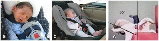 До скольки нужна коляска. Ребенок в автолюльке. Угол наклона новорожденного в автолюльке. Правильное положение новорожденного в автолюльке. Расположение ребенка в автолюльке.