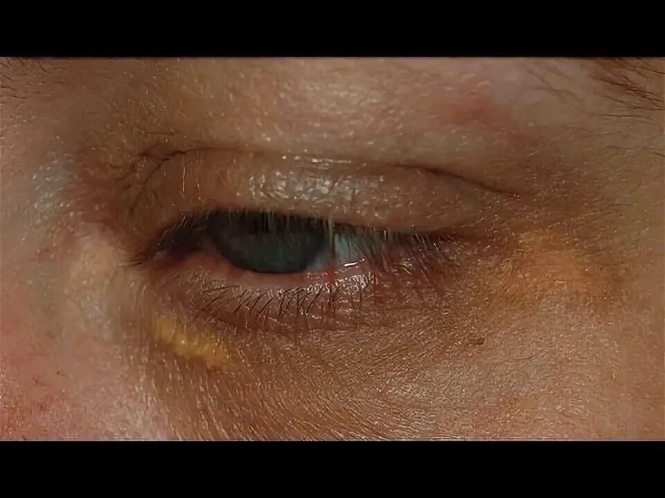 Как выглядит жировик на веке глаза фото Избавляемся от жировика возле глаза: эффективные и простые домашние методы Творч