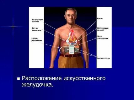 Сколько весит искусственный левый желудочек для сердца