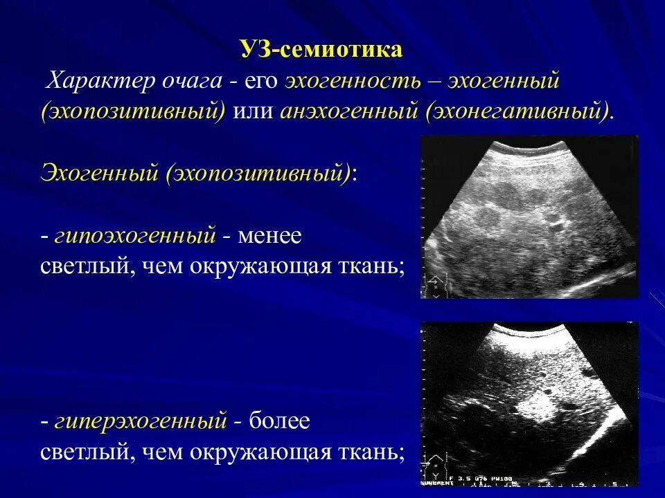 Гиперэхогенные структуры. Анэхогенные структуры. Гиперэхогенная структура. Что означает эхогенность печени