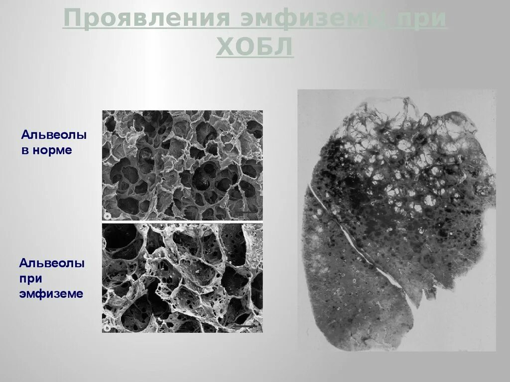 Вылечить эмфизему легких. Альвеолярная эмфизема легких. острая альвеолярная эмфизема. альвеолярная эмфизема легких курильщика. хроническая альвеолярная эмфизема.