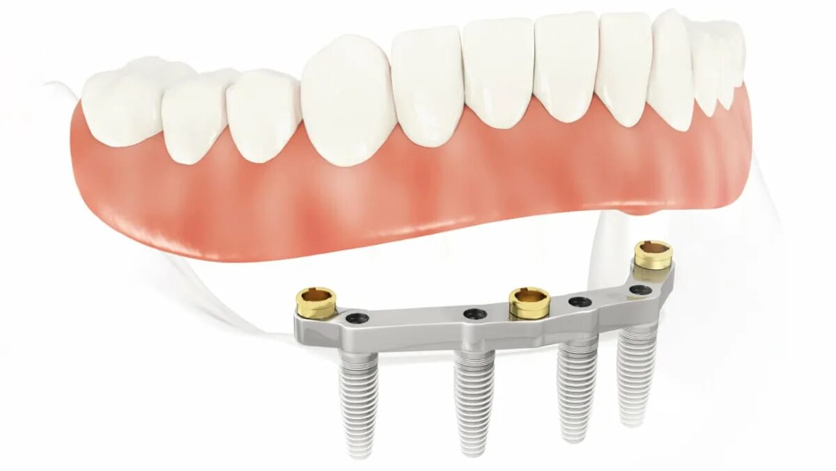 Балочный протез на имплантах. Балочный протез на 4 имплантах. Миниимпланты съемный протез. Покрывной протез на 4 имплантах.