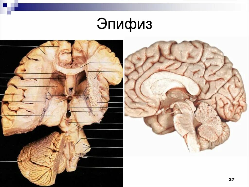Шишковидная железа. Эпифиз мозга шишковидное тело. Строение мозга эпифиз. Эпифиз головного мозга анатомия. Пинеальная железа головного мозга что это такое.