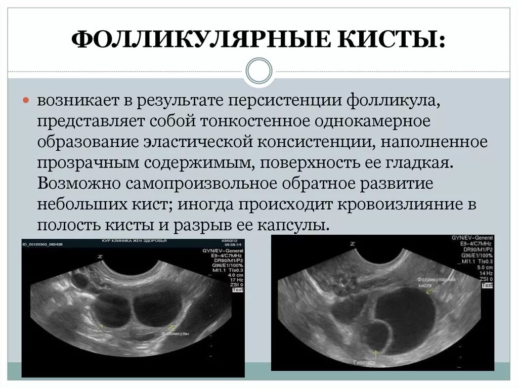 Образование округлое в яичнике. Персистирующий фолликул яичника УЗИ. Фолликулярная киста яичника на УЗИ. Функциональная киста яичника на УЗИ. Фолликулярная киста яичн.