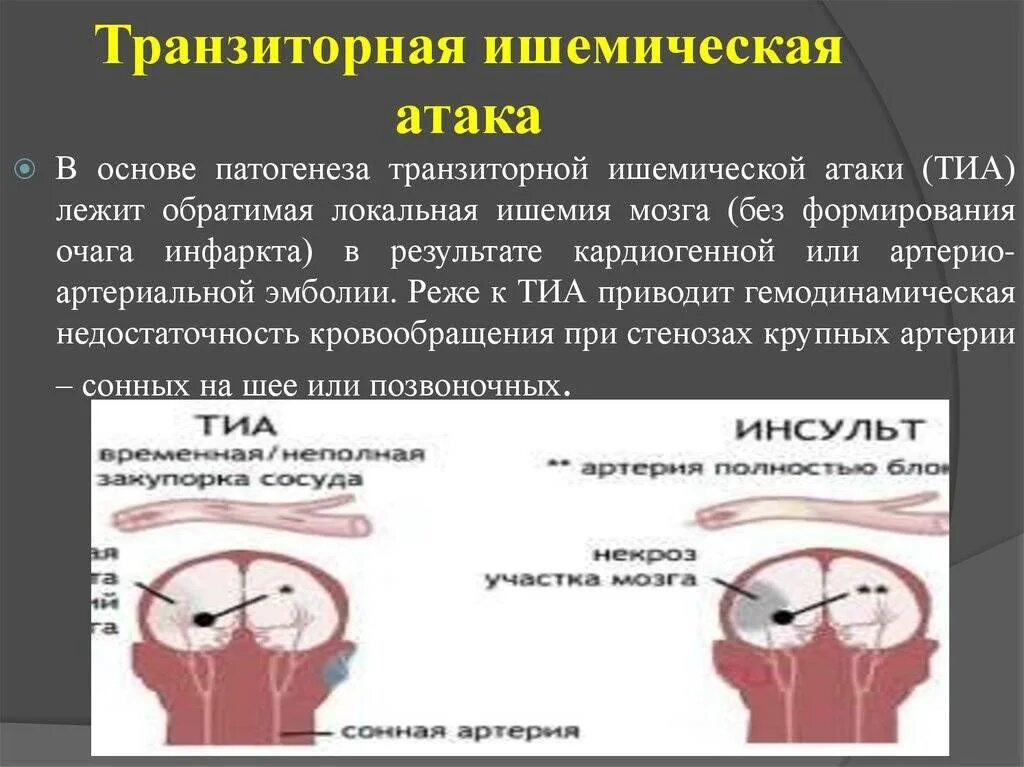 Что такое транзиторная ишемическая атака. Транзиторные ишемические атаки. Торзитарно ишемическая атака. Транзиторная ишемическая атака симптомы. Транзиторноишимическая атака.