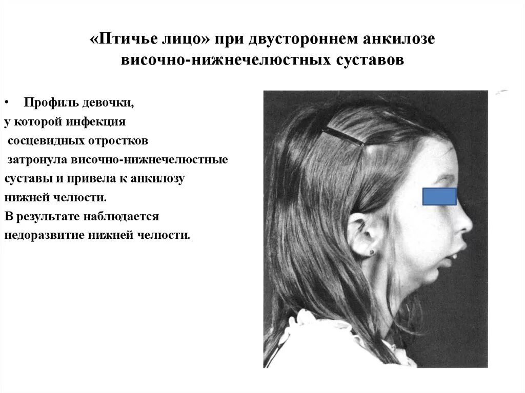 Заболевание нижней челюсти. Патология височно-нижнечелюстного сустава. Заболевание височно- нижнечелюстных суставов (ВНЧС).