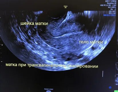 Узи матки трансвагинально