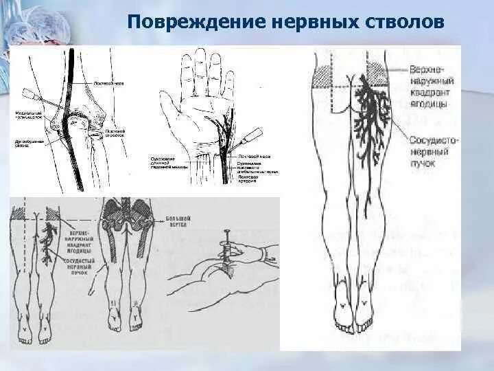 Поражение нервных стволов при инъекции. Постинъекционные осложнения повреждение нервных стволов. Травмы периферических нервов.