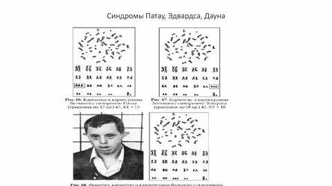 Кариотип больного с синдромом патау