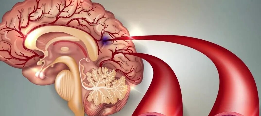 Закупоривание сосудов головного мозга. Закупорка артерий головного мозга. Атеросклероз сосудов головного мозга. Закупорка головных сосудов