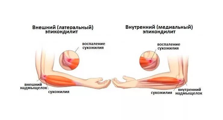 Какой врач лечит локтевые суставы. Медиальный эпикондилит гимнастика. Эпикондилит локтевого сустава. Латеральный эпикондилит локтевого. Латеральный эпикондилит сухожилие.