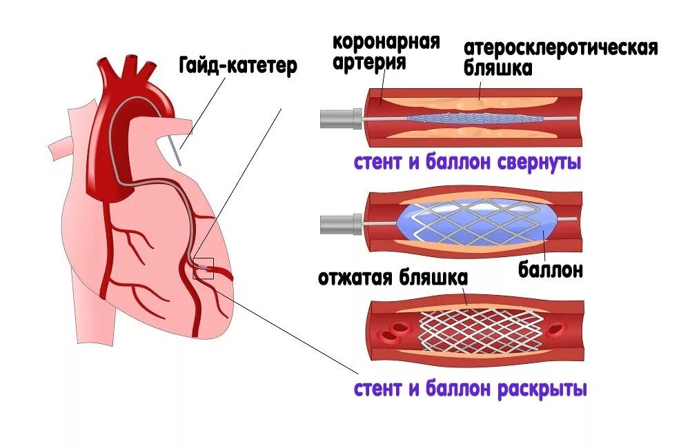 Как ставят стент