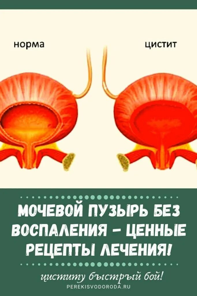 Заболевания почек и мочевого пузыря. Воспаление мочевого пузыря.