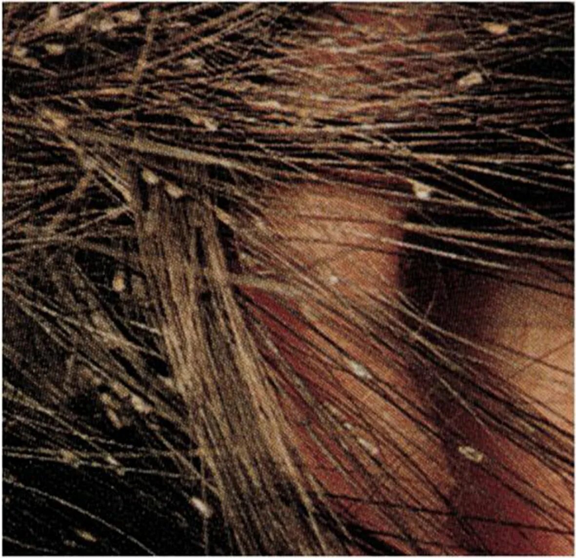 Против вшей. Капсулы вшей. Гниды на гребне. Гребень для вычесывания вшей. Педикулёз шампунь.