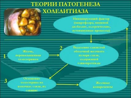 Образование желчных камней