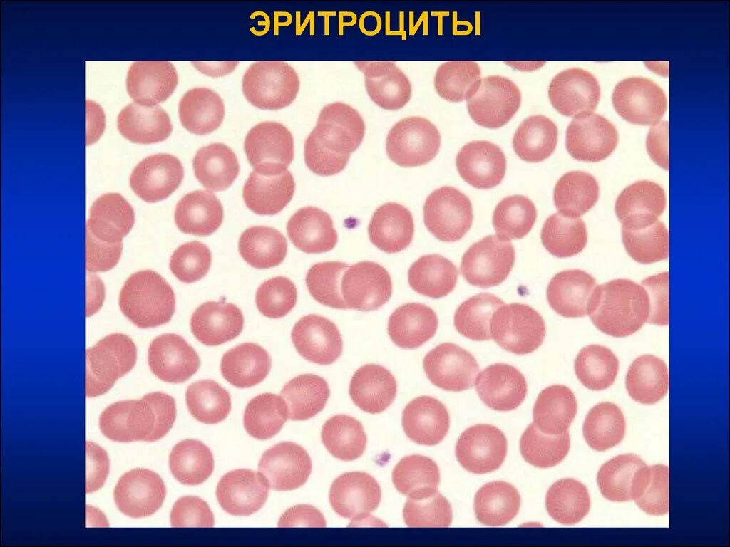 Пониженные макроциты. Гиперхромия макроцитоз. Макроциты и мегалоциты. Микроциты макроциты мегалоциты. Эритроциты.