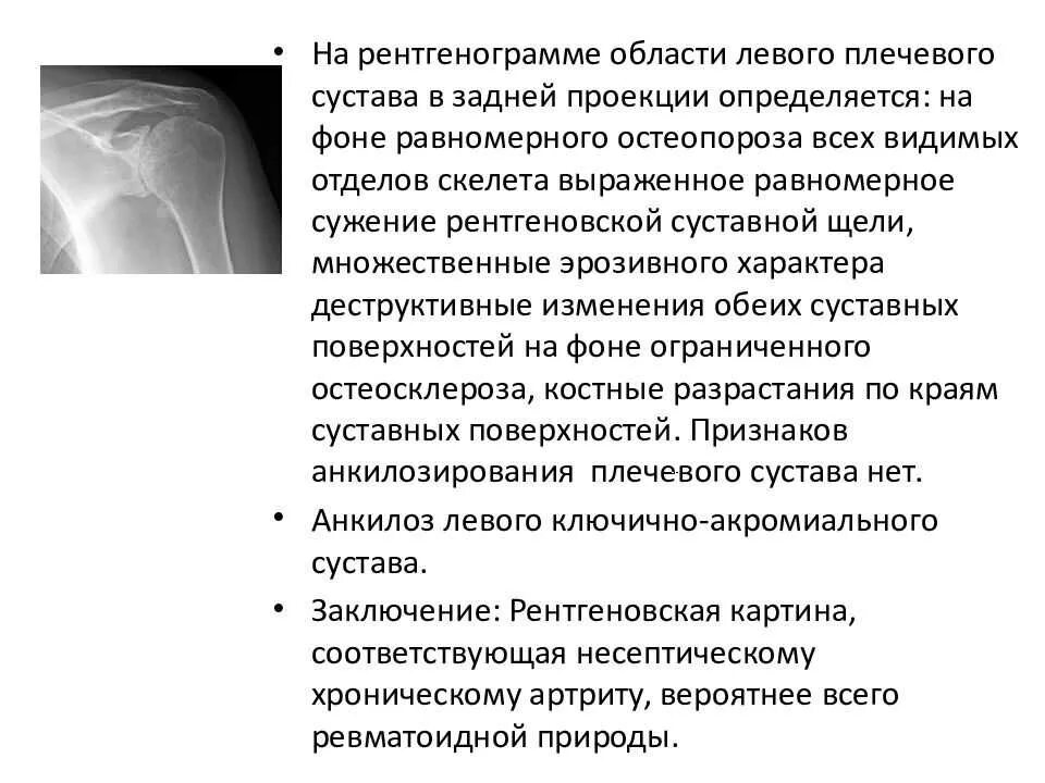 Плечевой периартрит что это. Артроз плечевого сустава кт. Плечелопаточный периартрит рентген. Артроз плечевого сустава стадии рентген. Ревматическое воспаление плечевого сустава..