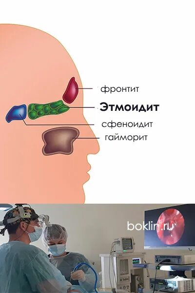 Сфеноидит форум. Симптомы острого Гнойного сфеноидита. Гайморовы пазухи сфеноидит. Сфеноидит клиническая картина. Сфеноидит воспаление клиновидной пазухи.