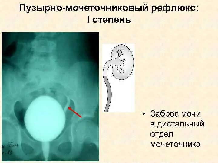 Мочеточник дистальный. Пузырно-мочеточникового рефлюкса. 1 Степень пузырно-мочеточникового рефлюкса. Пузырно-мочеточниковый рефлюкс пассивный. Рефлюкс мочеточников 3.