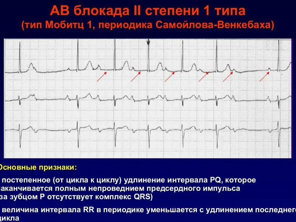 Предсердная блокада. Периоды Самойлова Венкебаха. ЭКГ внутрипредсердная блокада av блокада 2 степени. AВ блокады 2 степени с периодами Самойлова Венкебаха. АВ блокады сердца на ЭКГ.