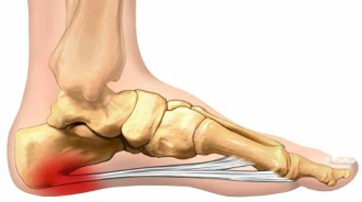 После ходьбы сильно болят. Плантарный фасциит рентген. Пятка больно наступать. Боли в ступне между пяткой и носком.