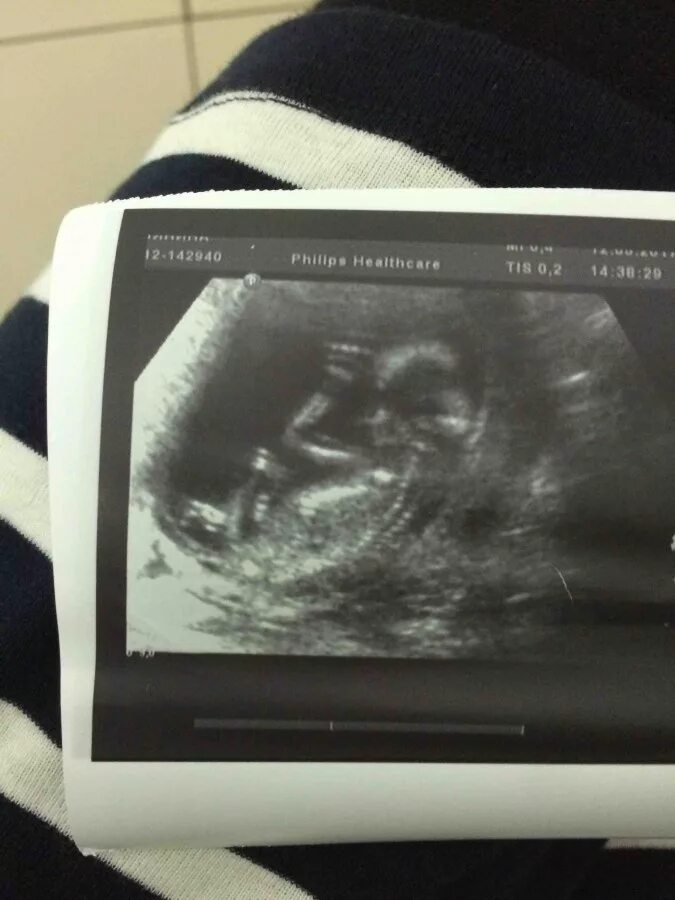 первый скрининг 13 недель. узи первый скрининг. узи 2 триместр беременности. узи 1 скрининг видное. скрининговое узи при беременности.