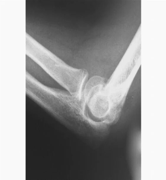 Перелом лучевой запястной кости. Срастание костей при переломе 5 плюсневой кости. Перелом лучевой запястной кости. Костная мозоль большеберцовой кости рентген. Срастание перелома со смещением.