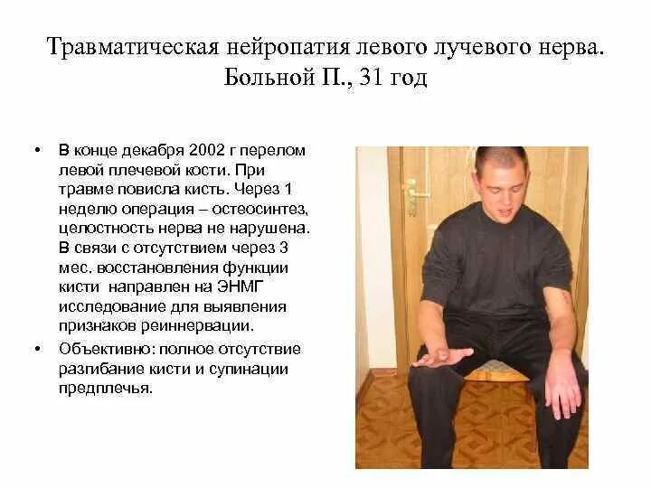 Нейропатия инвалидность. Посттравматическая нейропатия. нейропатии лучевого нерва. травматические нейропатии. посттравматическая нейропатия лучевого нерва.