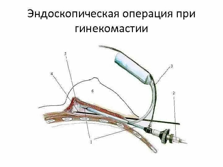 Мужчины увеличение полововой орган. Операция при гинекомастии. Этапы эндоскопической операции. Операция под местной анестезией.