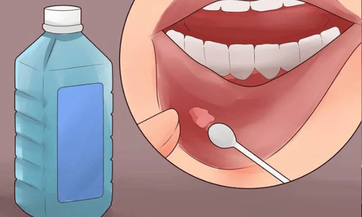 Чем можно обрабатывать рот. Рецинзиозная киста на губе. Ретенционные кисты губы.