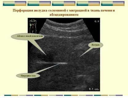 Узи полых