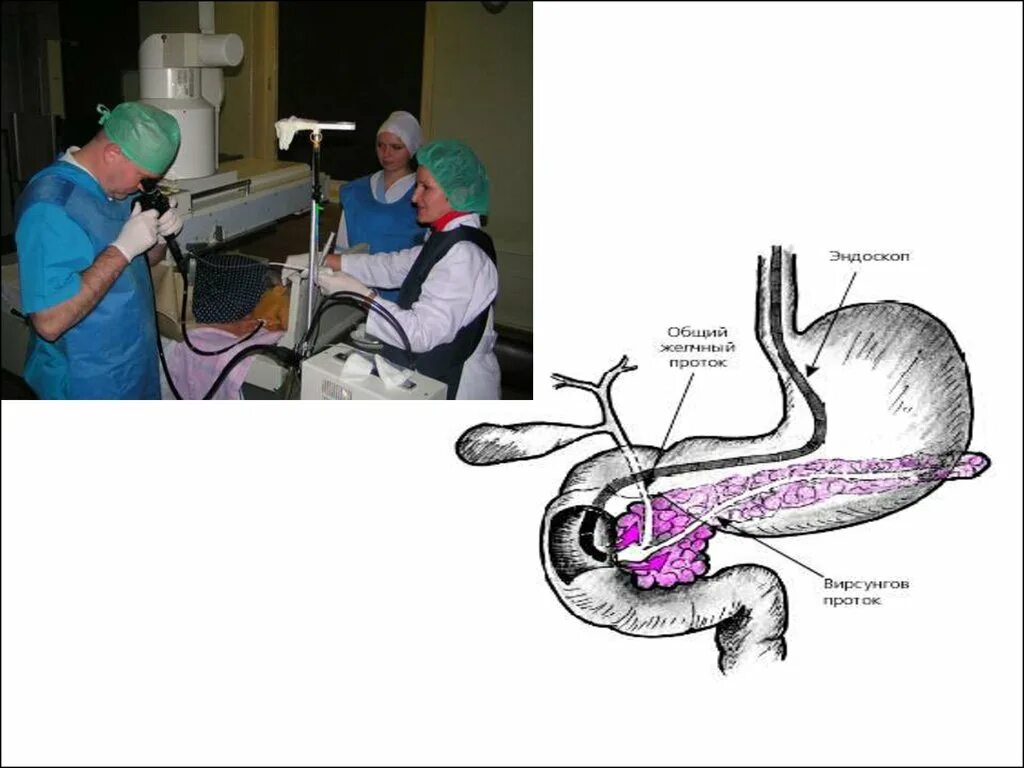 Вирсунгов проток при панкреатите. Поджелудочная железа панкреатит операция