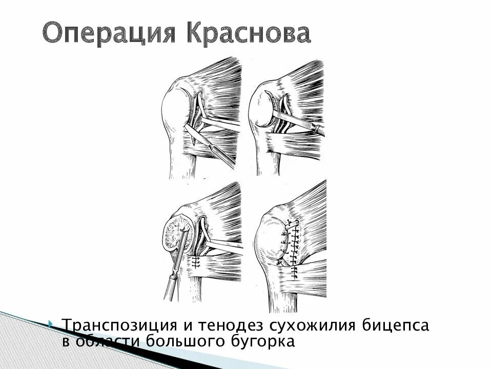 Тенодез сухожилия бицепса. Операция при привычном вывихе плеча. Тенодез длинной головки бицепса плечевого сустава.