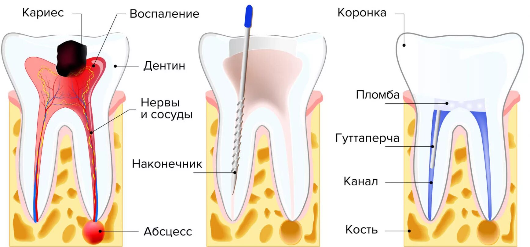 Зуб чувствителен после лечения. Пульпит 2 канального зуба. Пульпита (депульпирование зуба.