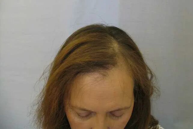 Причёски при алопеции у женщин. После лучевой волосы выпадают