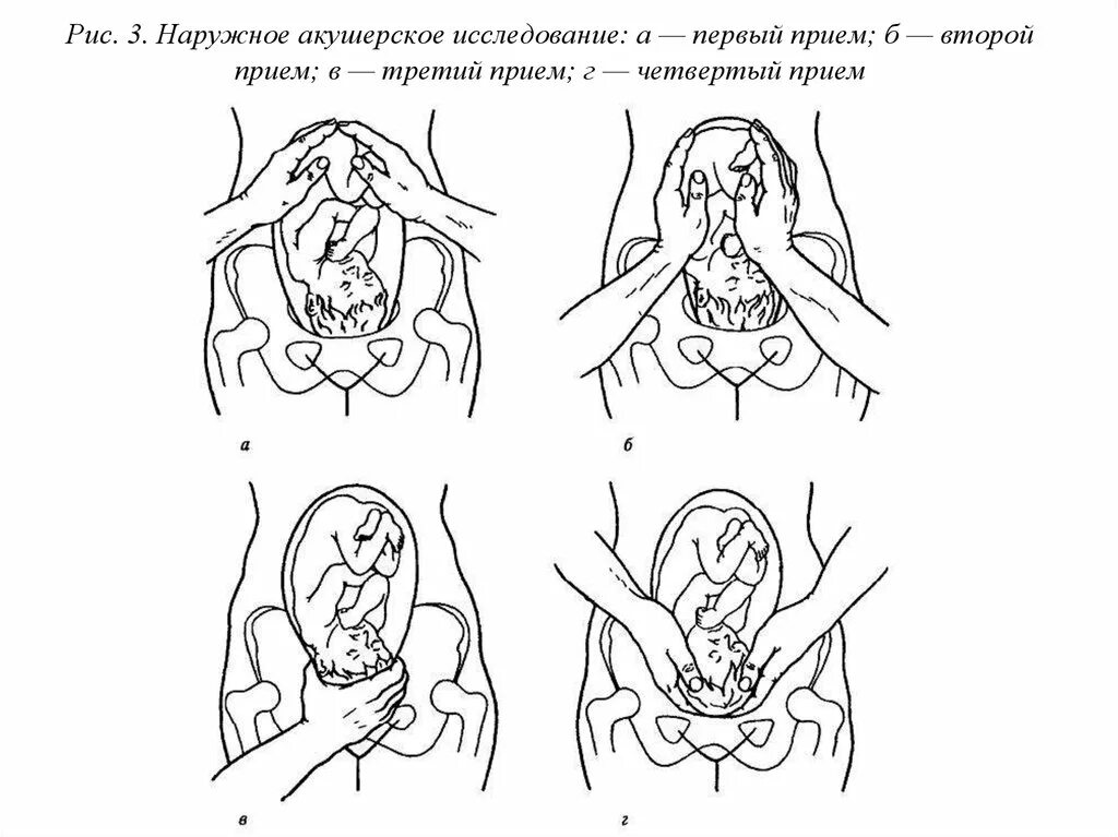 Позиция плода в акушерстве. Приемы наружного акушерского исследования Леопольда Левицкого. Приёмы Леопольда Левицкого в акушерстве. Наружное акушерское исследование приемы Леопольда Левицкого. Третий прием Леопольда-Левицкого.