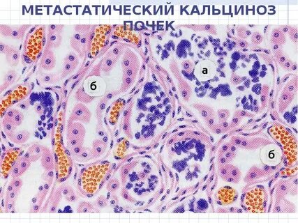 Дистрофический очаг