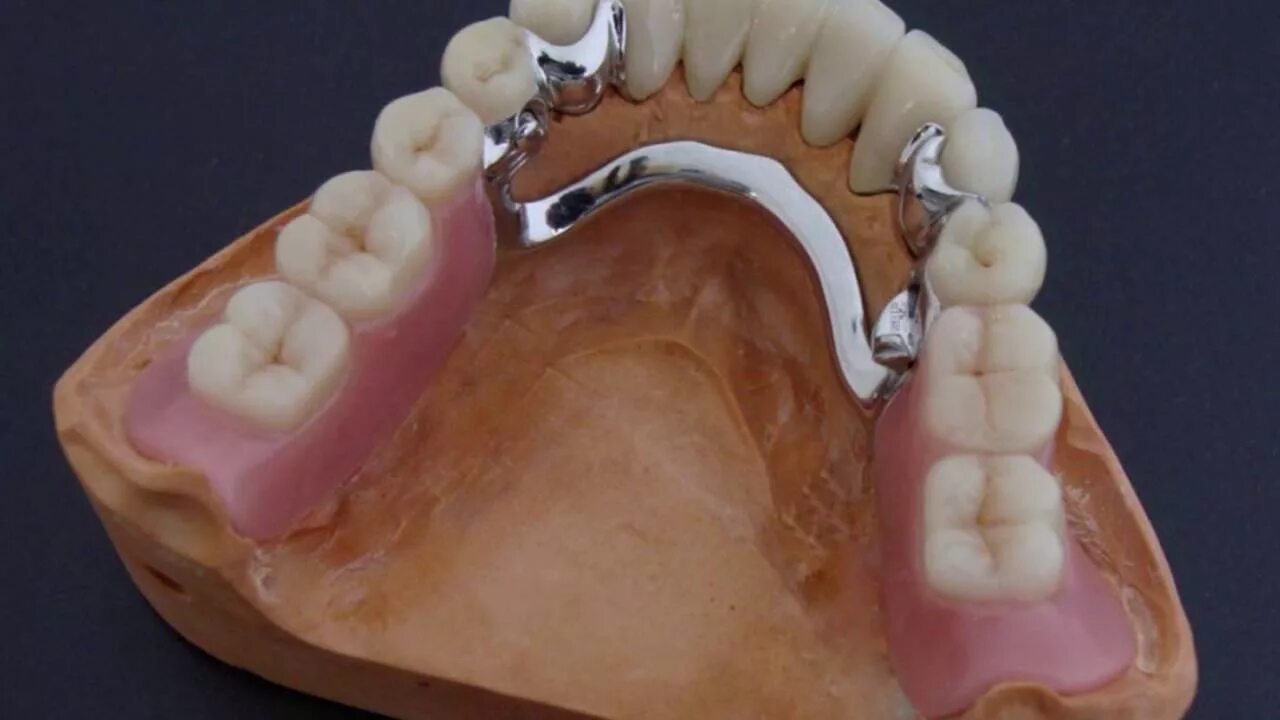 Бюгельный протез (2-3 кламмера). Бюгельный протез кламмерный (remanium-700). Бюгельный протез Дентал-ди (a16.07.036. Как крепятся съемные