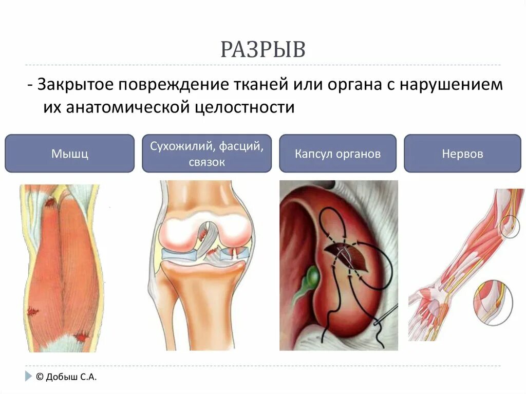 Разрыв закрытое повреждение. Закрытые механические травмы. Механические повреждения мягких тканей.