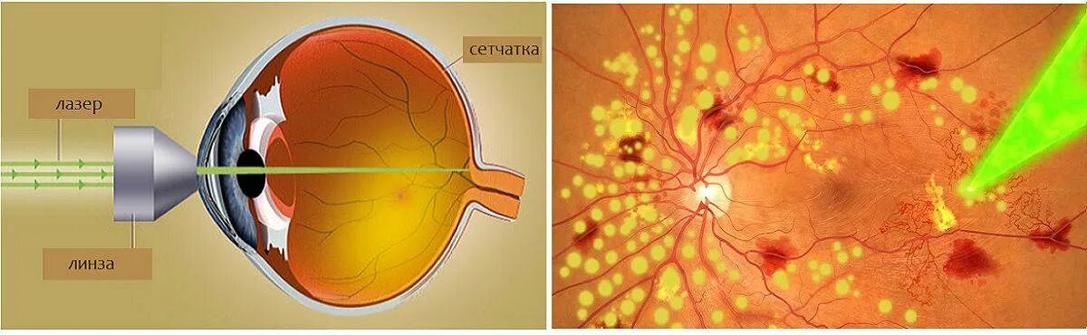 Периферическая лазеркоагуляция сетчатки глаза. Периферическая витреохориоретинальная дегенерация сетчатки глаза. Отслоение сетчатки глазное дно. Лазерная коагуляция сетчатки ПВХРД. Лазерная коагуляция после операции
