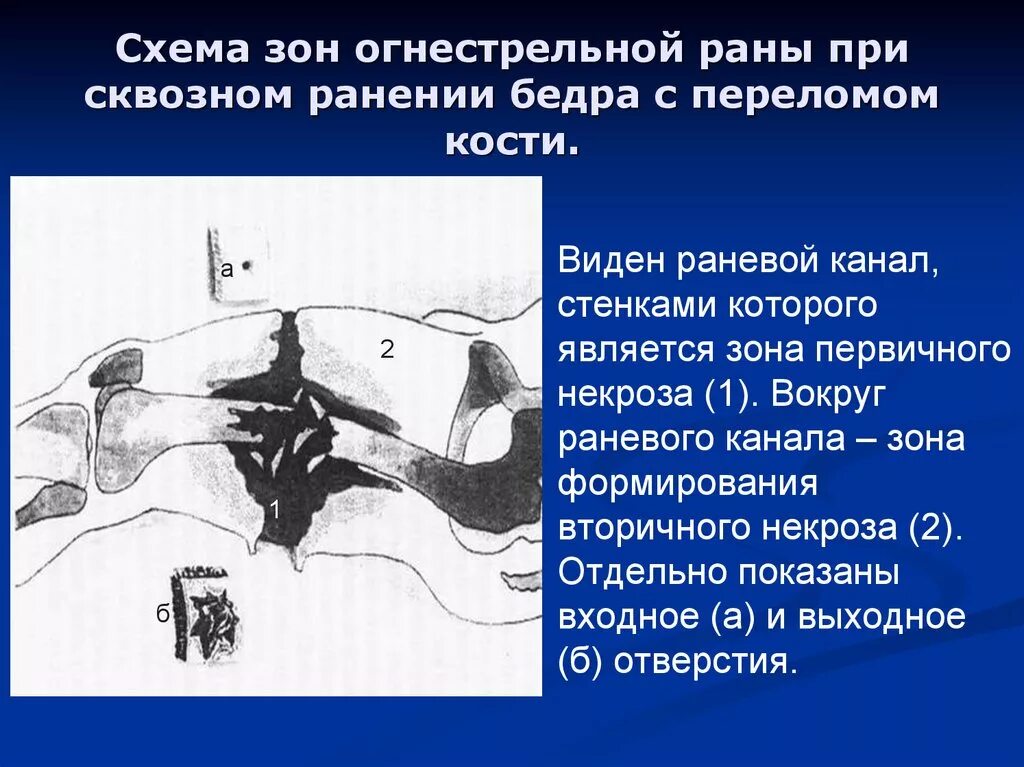 Разрыв пик. Огнестрельное ранение схема. Сквозное огнестрельное ранение. Осколочное огнестрельное ранение. Огнестрельное сквозное ранение бедра.