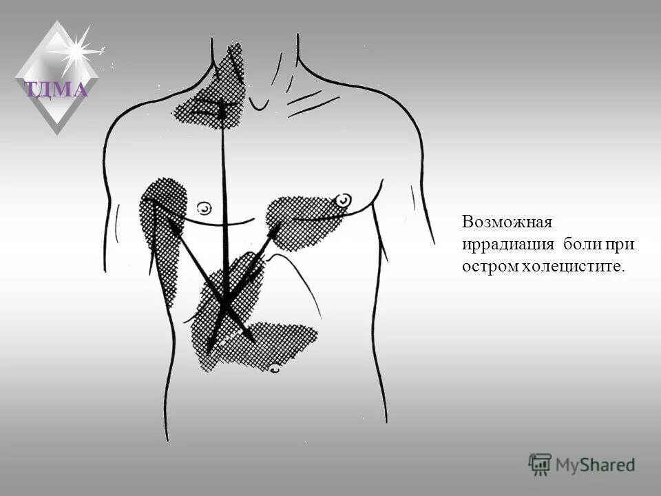 Острый холецистит иррадиация болей. Иррадиация боли при холецистите. Иррадиация при остром холецистите. Локализация боли при остром холецистите.