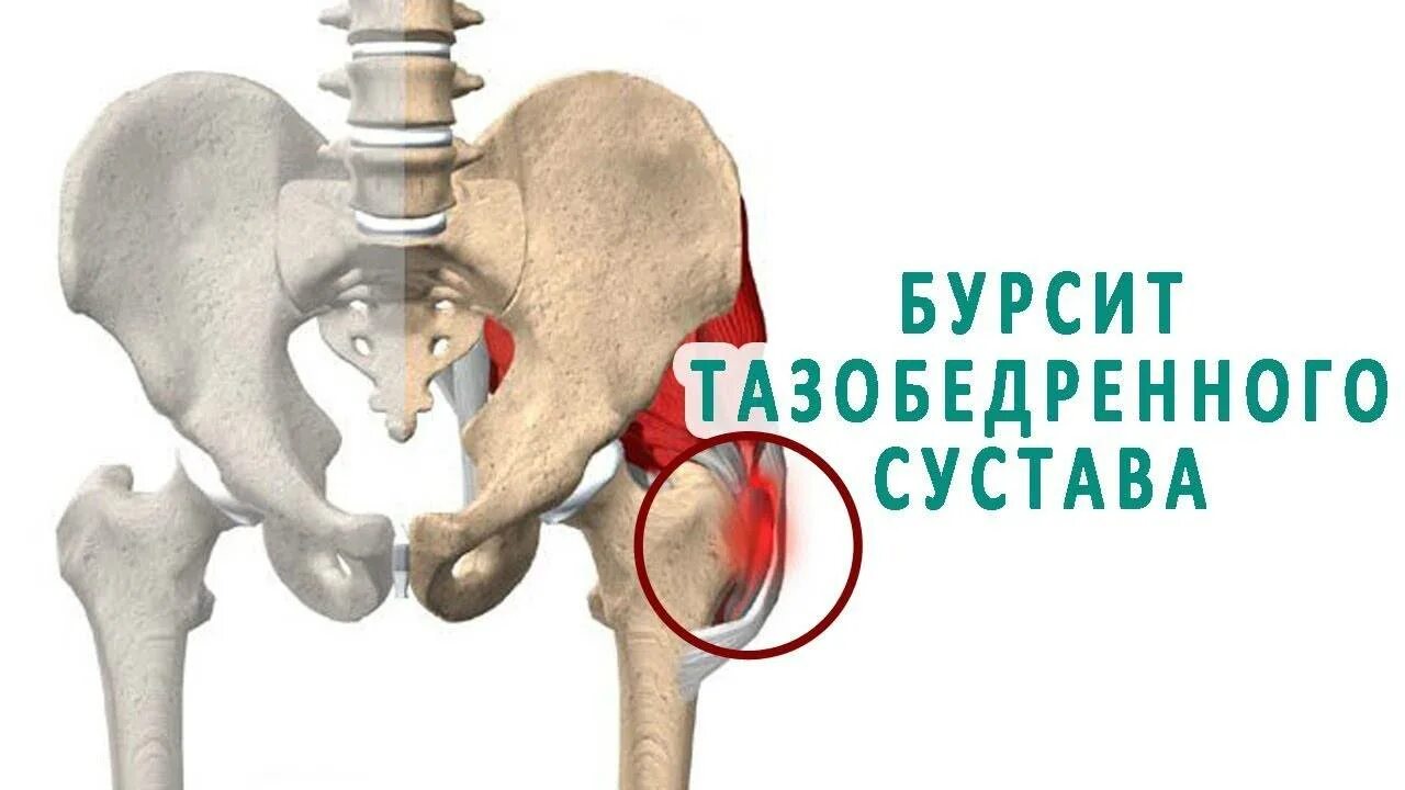 Вертельная сумка тазобедренного сустава. Вертельный бурсит тазобедренного. Седалищный бурсит тазобедренного. Хронический Вертельный бурсит. Медицина суставы тазобедренный