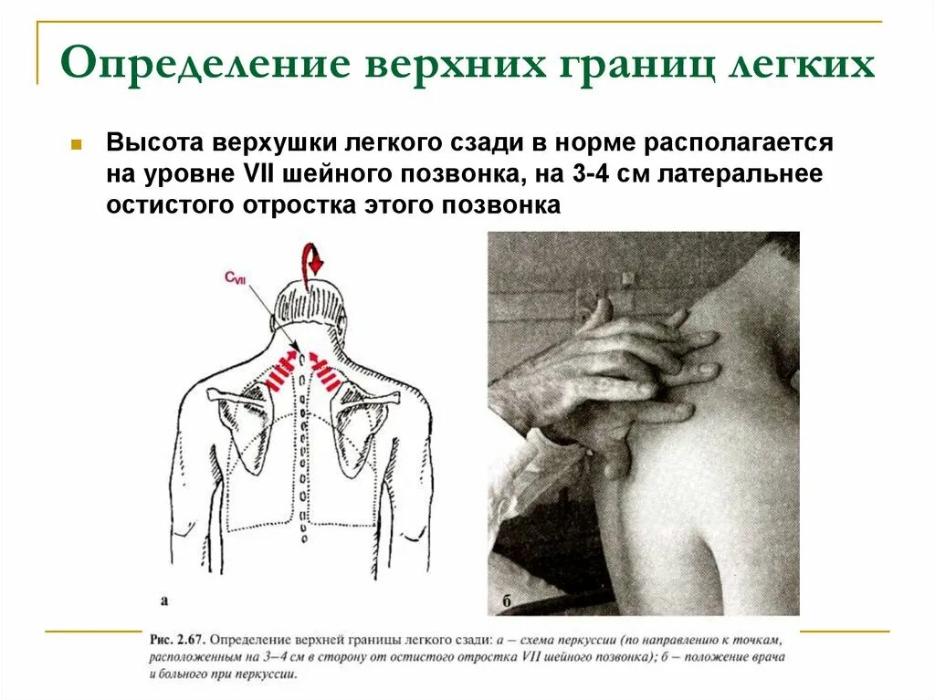 Перкуссия верхней границы легких спереди. Высота стояния верхушек легких спереди. Верхушки легких в норме