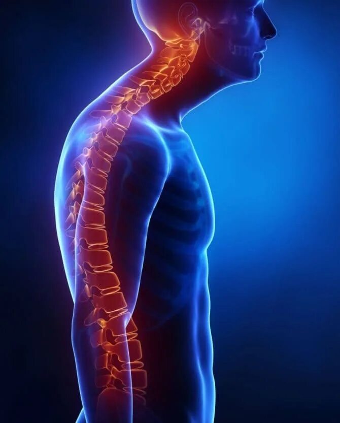 Сутулость биология. Искривление позвоночника кифоз. Сколиоз круглая спина. Искривление позвоночника лордоз. Искривление позвоночника болезнь шейермана мау.